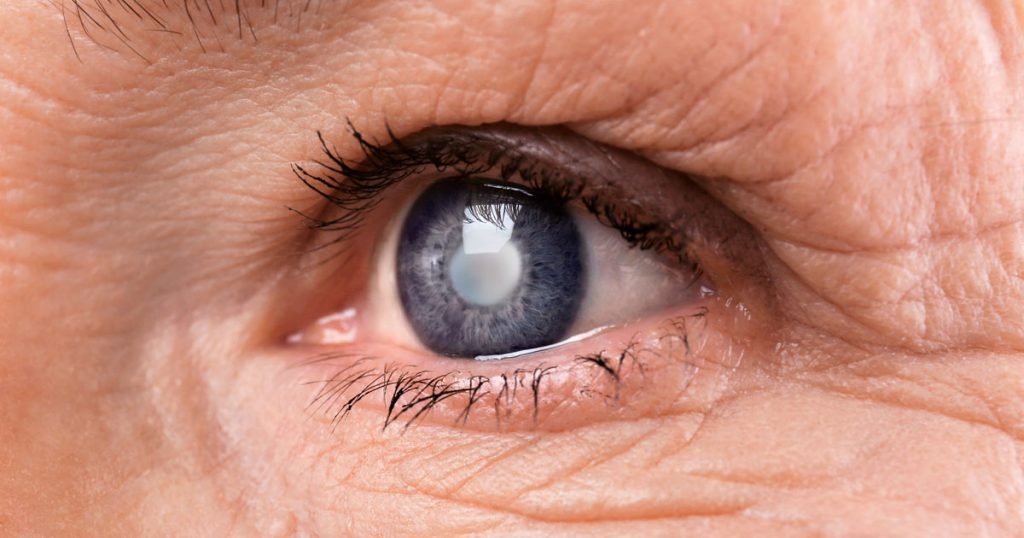 Cataracta