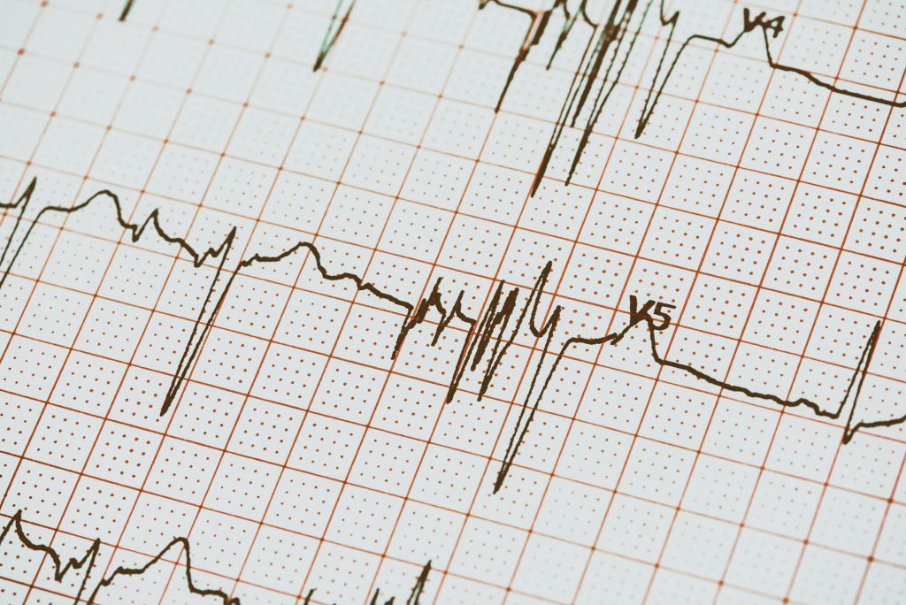 Extrasystoles On Electrocardiogram Record Paper