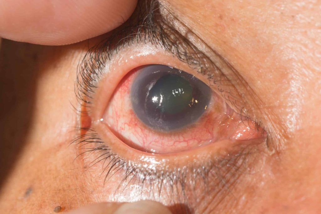 Glaucomul